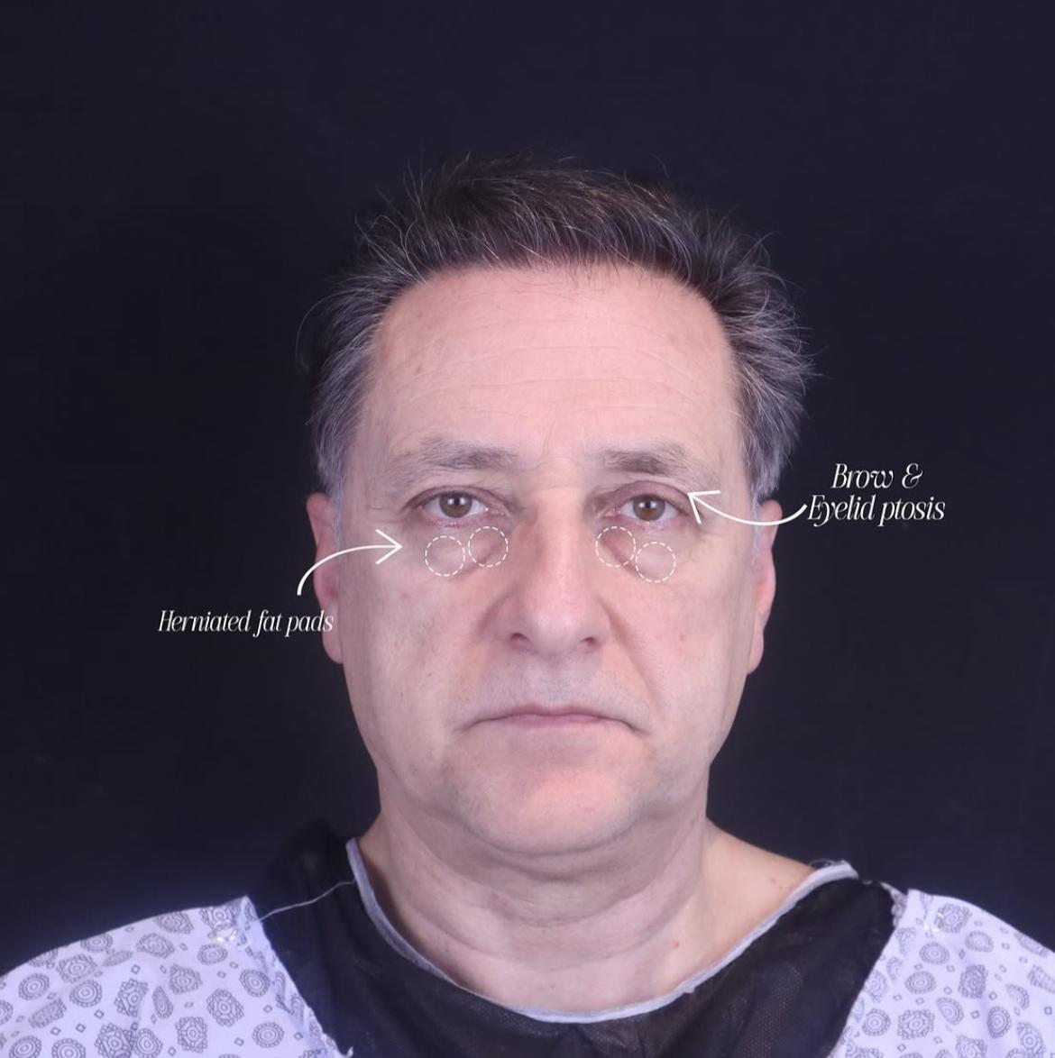 Eyelid Surgery · Plastic Surgery
