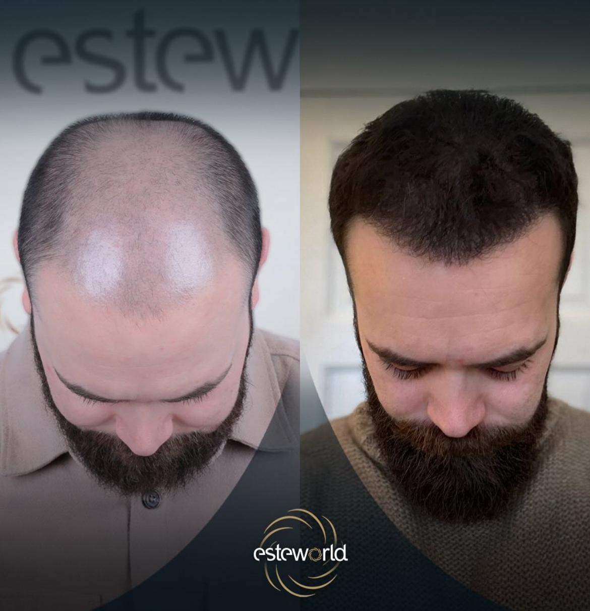 Hair Transplant · Hair Transplant