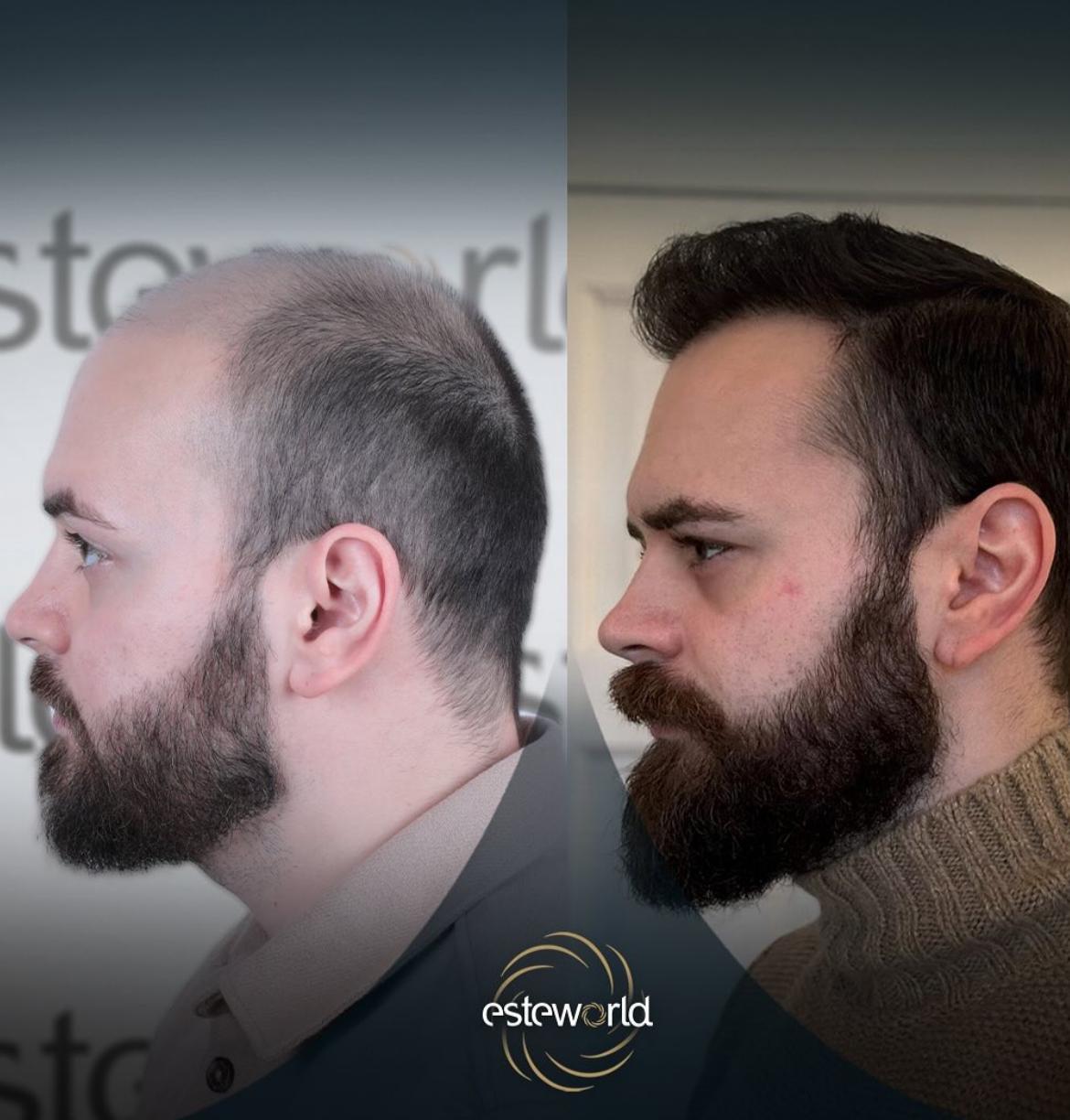 Hair Transplant · Hair Transplant