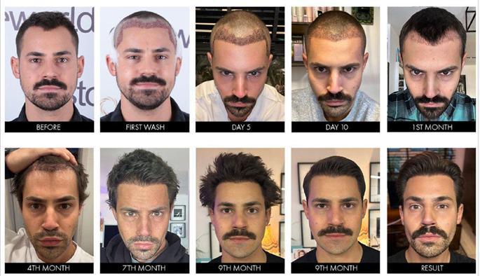 Hair Transplant · Hair Transplant