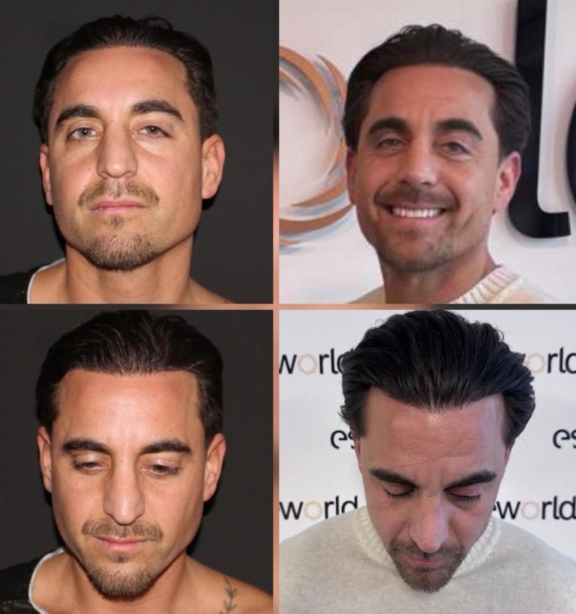 Hair Transplant · Hair Transplant