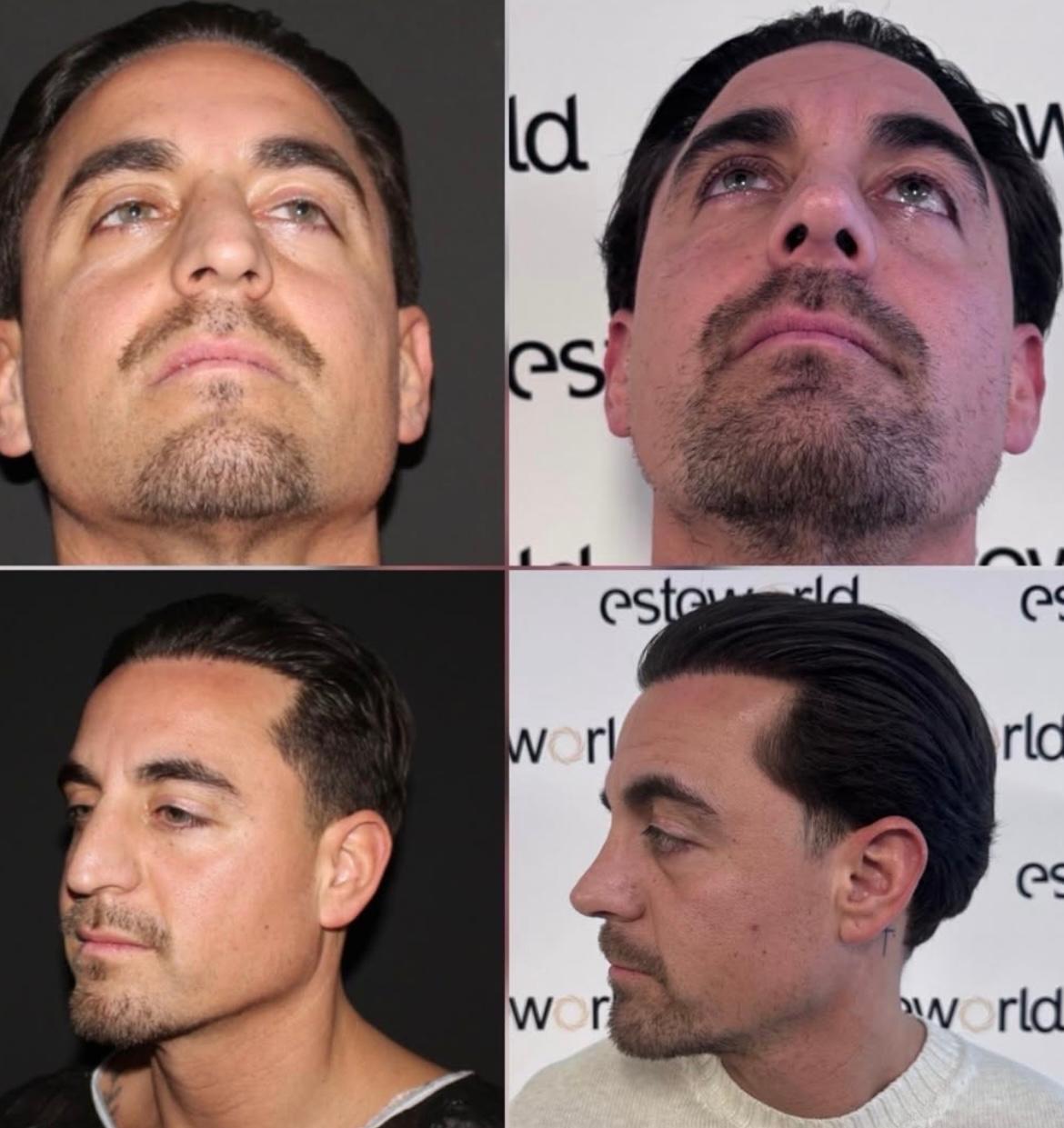 Rhinoplasty · Plastic Surgery