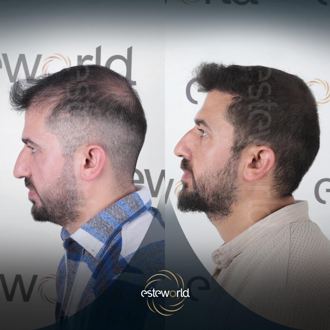 Hair Transplant · Hair Transplant