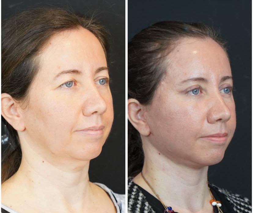 Facial Rejuvenation · Non-invasive Treatments