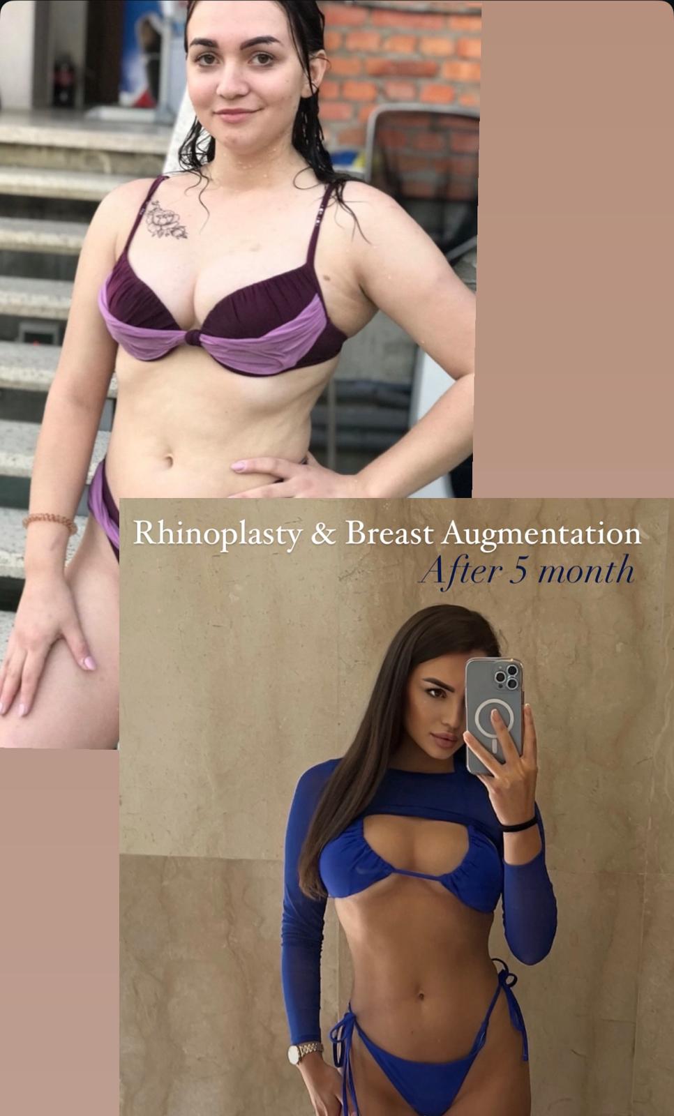 Rhinoplasty & Breast Augmentation · Plastic Surgery