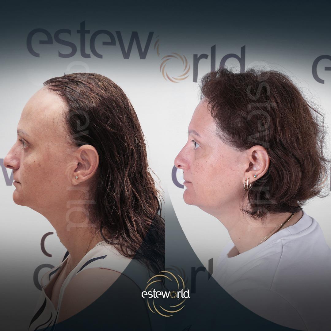 Facelift · Plastic Surgery