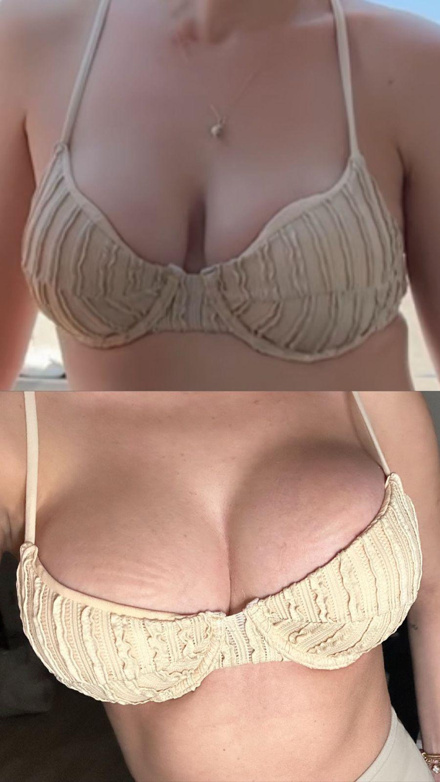 Breast Augmentation · Plastic Surgery