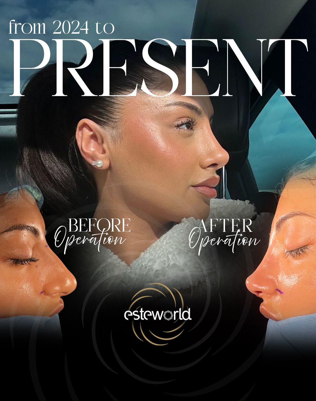 Rhinoplasty · Plastic Surgery