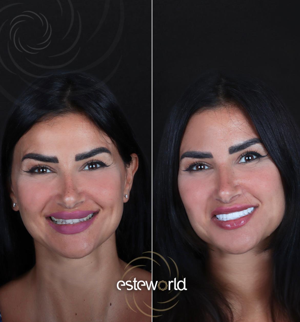 Hollywood Smile · Dental Treatments