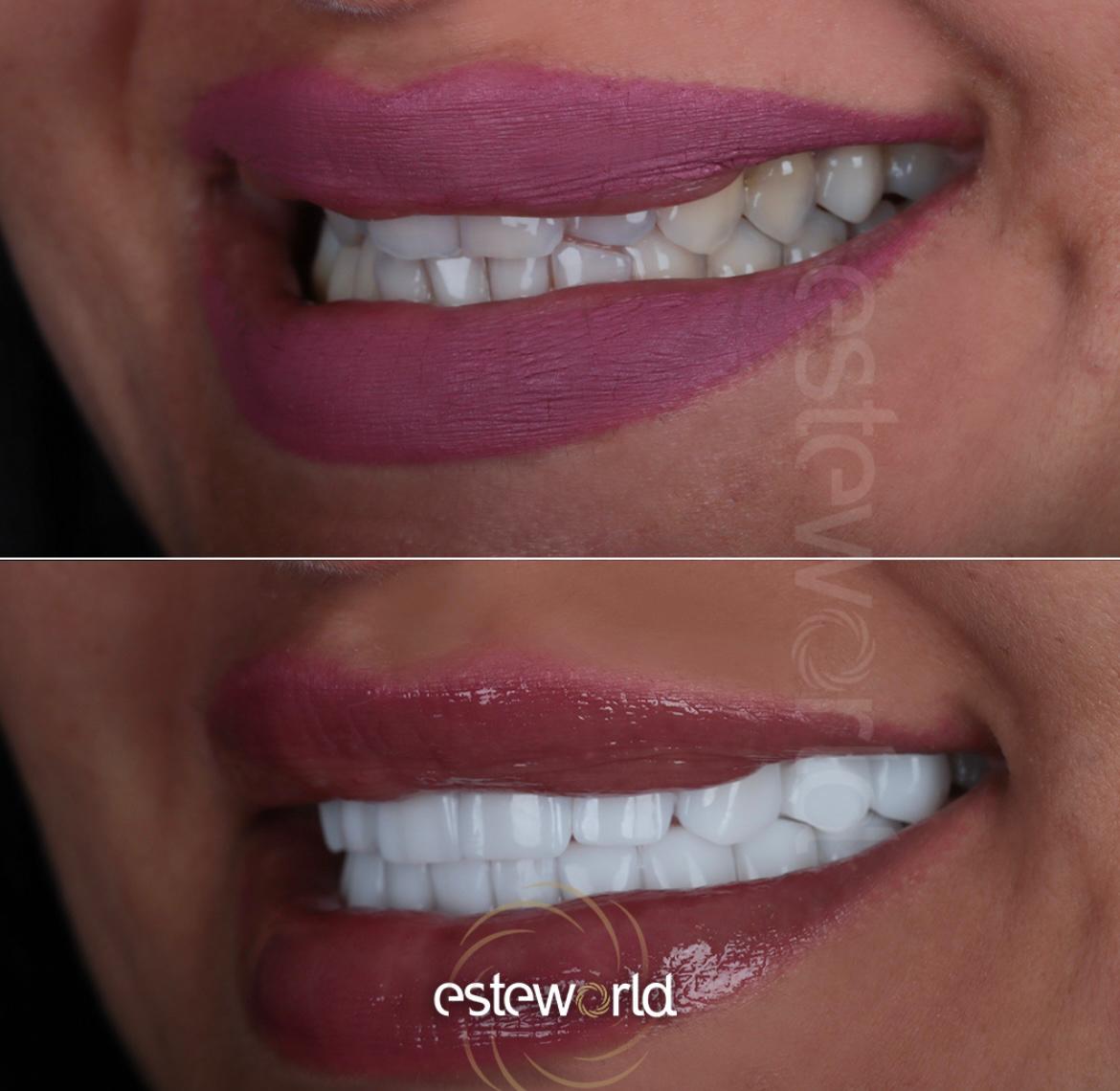 Hollywood Smile · Dental Treatments